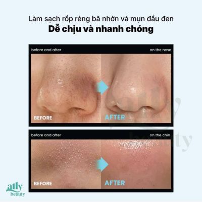 Dụng Cụ Làm Sạch Mụn Đầu Đen ILSO Deep Clean Master l