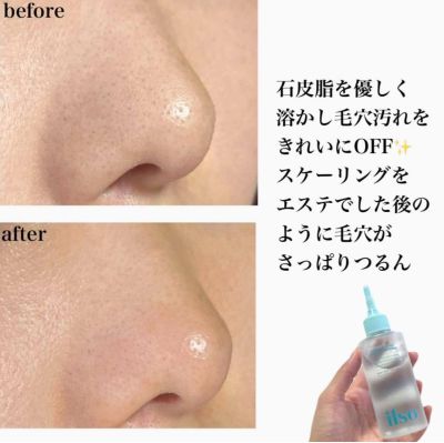 Dụng Cụ Làm Sạch Mụn Đầu Đen ILSO Deep Clean Master l